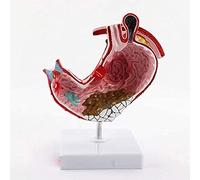 Modelos Modelo de anatomía, Modelo de anatomía del estómago, Modelo anatómico médico 1: 1 Modelo de lesión gástrica Humana Modelo patológico de anatomía del estómago. Herramientas Esenciales