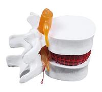 Niniang Anatomía Esqueleto Columna vertebral Disc Lumbar Hernia Enseñanza Modelo Cerebro Cráneo Traumático Suministros Escolares Instrumento