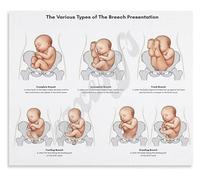 Obstetric Reference Poster Breech Presentation Frank Complete Footling Types for Maternity Ward Skills Lab(Framed,08x12inch(20x30cm))