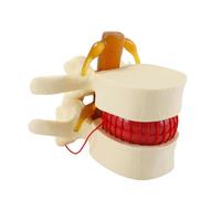 Orivin Modelo anatómico vertebral lumbar - Modelo de demostración de hernia discal lumbar humana (1,5x) (amarillo)