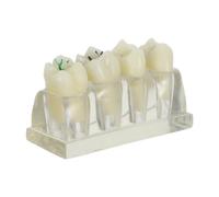 OSOLADY Modelo Educativo de Diente Caries Realista de Abs para Enseñanza Oral y Comunicación Pacientes en Higiene Dental