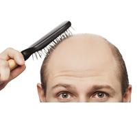 Paga 249 € por un descuento de 3.900 € en un trasplante capilar con técnica FUSS o FUE