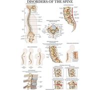 Palace Learning Póster de anatomía de trastornos de la columna vertebral, gráfico anatómico laminado de trastornos de la columna vertebral, 45,7 x 61 cm