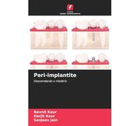Peri-implantite: Desvendando o mistério