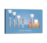 Professional Dental Implant Chart, Anatomy & Placement Diagram, Wall Art for Dental Schools and Practices(Framed,12X18inch(30X45cm))