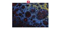 Proteína C-reativa e diagnóstico de cancro