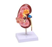 Pyatofly Modelo de PatologíAs Renales RéPlica de AnatomíA del Cuerpo Humano de RiñóN Enfermo para Doctor Herramienta Educativa de Oficina AnatóMicos