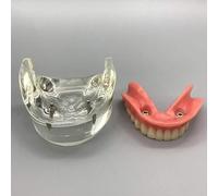 RAYACO Modelo Dental - Modelo de Dientes de Implantes Dentales- Sobredentadura Dental Mandibular Inferior 2 Implantes Demo para Enseñar y Estudiar