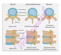 REIUAFWYGV Types of Spinal Stenosis Poster Cervical Lumbar Central Canal Narrowing Health Wall-Art Decor(Unframed,12x18inch(30x45cm))