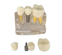 Resina de implantes dentales Modelo - Dientes Dentales Modelo de Educación Modelo - Puente corona de los dientes de demostración encías del cuidado del diente La enseñanza Estudio Tipodonto Modelo