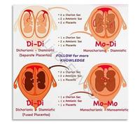 RQLVZHGK Placentation of Twins Educational Chart Diagram Poster Obstetric Anatomy Wall-Art Canvas for Living Room Bedroom Home Decor Framed,08x12inch(20x30cm)