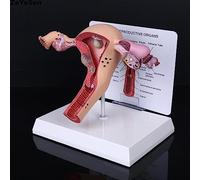 RSBFER Modelo de Ovario de útero patológico, Modelo anatómico Humano órgano genital Femenino, Muestra útero, Ovario, Vagina, enseñanza médica uterina