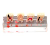 Sanfly Modelo De Dientes Dentales, Tratamiento De Endodoncia, Modelo Transparente De Demostración, Modelo De Enseñanza Dental para Estudio, Enseñanza, Educación del Paciente