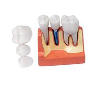 Sarini Modelo de Diente Oral, Modelo de implante Dental con Corona y Puente extraíbles, Adecuado para demostración en el Aula y formación de Estudiantes de odontología