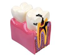 Sarini Modelo Dental, Modelo de Estudio de comparación de Caries, Modelo de enseñanza de anatomía Dental para Dentistas, Adecuado para Dentistas, Pacientes, Profesores y Estudiantes