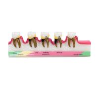 Sarini Modelo Periodontal Dental de 1 Pieza, Modelo de Desarrollo de Caries, Modelo de Periodontitis para Demostración de Enseñanza de Clasificación Periodontal de Modelos Dentales