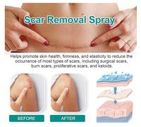 Scar Remove, Scar Remove Medical Grade Scar Spray, Scar Removal Spray, Acne Scars and Dark Spaot Remover (1pcs)