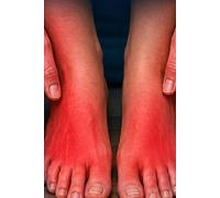 Secondary Erythromelalgia Why Heat Causes Burning Pain: Inflamed Extremities and Its Symptoms and Treatments.