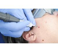 Sesión de tratamiento láser para la eliminación de hasta 3 verrugas lunares manchas o puntos rubí