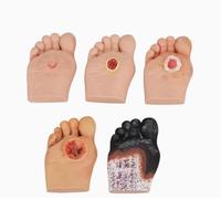 Set de modelos de pie diabético Modelo para el cuidado del pie diabético (5 piezas) Lesiones purulentas en heridas Simulador de pie diabético de grado 1 a 5 para enfermería