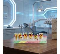 Shein 1 pieza Modelo del proceso de caries dental, Modelo de anatomía dental, Modelo de educación dental, Modelo de patología oral para demostración de ense