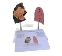 Simpls Modelo de Pulmón de Fumador Modelo de Pulmón Modelo de Anatomía Pulmonar con Pulmones Patológicos con Enfermedades del Respiratorio