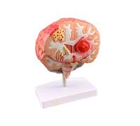Simulación del modelo de enfermedad cerebral humana Anatomía Neurocirugía Brain Patología cerebro Modelo médico anatómico