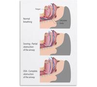 Sleep Apnea Education Poster Risk Factors Prevention Tips Wall Art Canvas Print for Living Room Study Room(Framed,16x24inch(40x60cm))