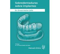 Sobredentaduras sobre implantes: Manual Clínico