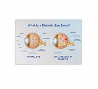 SSOPTMCB Diabetic Retinopathy Educational Chart Eye Anatomy Diabetes Reference Poster Wall-Art for Clinic Office Classroom(Framed,16x24inch(40x60cm))