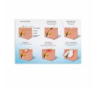 SSOPTMCB Facial Skin Analysis Acne Face Map for Skincare Routine and Home Decor(Framed,16x24inch(40x60cm))