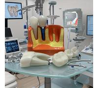 TEMU 1set 4x Dental, Demostración de Corona de de Implante Dental, de Descomposición de Implante Dental de Enseñanza Oral