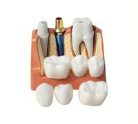 TEMU de Implante Dental 1pc - Equipo Dental Profesional, Plástico, Escenario de Implante 4x, Rosa, para Educación del / Presentaciones Dentales, Ideal para y Profesionales de Odontología