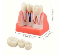 TEMU de Implante Dental con Dientes Removibles - 4 Dentales, Material PVC para Educación y Estudio Odontológico, Didáctico