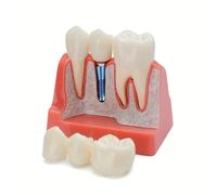 TEMU de implante dental móvil - Puente de corona 4x, material de PVC, ideal para uso educativo e investigativo, para tiendas dentales para exhibir