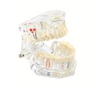 TEMU de Implante Dental y Restauración - Patológico/ Desmontable con Pieza Desmontable, Adecuado para Entrenamiento, Práctica de Implantes, Prostodoncia - Simulación Realista de Cirugía Oral