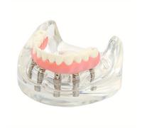 TEMU Kit de de implante dental de 1 pieza - Conjunto de exhibición de silicona para educación dental, estudio de anatomía y planificación quirúrgica - Dentadura con de implante