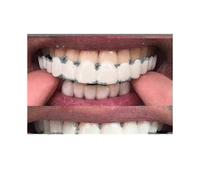 (The Baby Tooth Under)Snap On Smile Dental Veneers Comfort Fit Flexible False Teeth Cover For Cosmetic Smile Enhancement Temporary Use -YT4