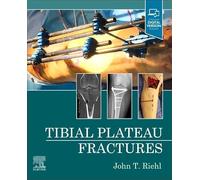 Tibial Plateau Fractures