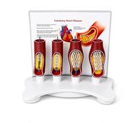 TQPGJJL Modelo Profesional De Stent Vascular - Arteria Coronaria Anatómica De PVC Agrandada con Demostración De Bloqueo, Material Didáctico Precisión para Formación Médica Y Cardiología