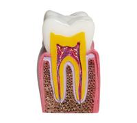 TTETTZ 6 Veces El Modelo de Diente de Caries para La Educación en El Aula Y Explicación de Los Estudiantes