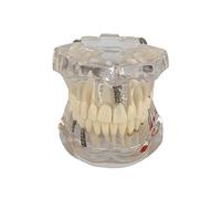 UGD8TQR Transparent Disease Dental Teeth Model Clear Dental Model Human Body Anatomy Replica of Jaw for Dentist Office Educational Tool.