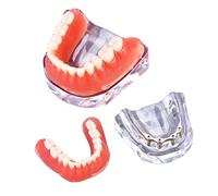 UIGJIOG Demostración Modelo Diente Modelo Dental Prótesis Dientes Modelo De Sobredentación De Sobredentes De Precisión Enseñanza Modelo De Dentición, Nuevos Modelos De Plantación Y Restauración 4 Uñas
