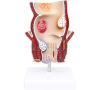 UIGJIOG Modelo De Anatomía Patológica Rectal Humana 5 Veces El Tamaño Modelo Patológico Rectal Modelo Anorrectal De Patología del Acné Enseñanza Hemorroides Patología Anatómico Rectal Intestinal