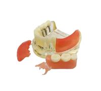 UIGJIOG Modelo De Dientes De Restauración Implantes Dentales Comparison of Implant-Supported Restorations Modelo De Implante De Dientes Transparentes Modelo De Educación Y Estudio