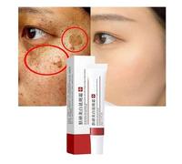 Whitening Freckle Cream,Acne Scar Removal Treatment Cream,Pigmentation Removal Cream for Face, Anti-wrinkle Moisturizing Anti-blemish Effective Remove Melasma Melanin Dark Spots (1 Pcs)