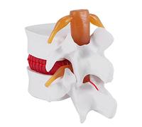 Widybord Modelo de demostración de hernia de disco lumbar humano 1:1.5 de modelo de columna vertebral lumbar para anatomía