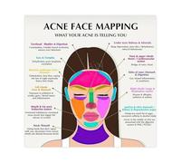 XGINERFEX Acne Face Mapping Chart Canvas Print Skin Analysis Reference Poster for Esthetician Office and Spa Training Room Decor(Framed,08x12inch(20x30cm))