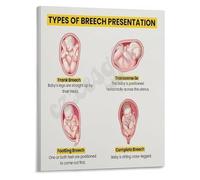 XGINERFEX Fetal Malpresentation Poster Breech Types and Management Guide for Students and Residents Canvas Print(Unframed,12x18inch(30x45cm))