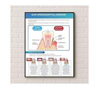 XGINERFEX Health Education Poster Periodontal Disease Chart Showing Plaque Calculus and Gum Disease Canvas Wall-Art for Clinic Classroom(Unframed,12x18inch(30x45cm))